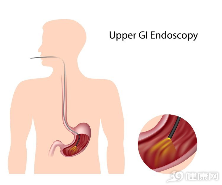 做胃鏡難受嗎？全面解析胃鏡檢查的體驗(yàn)與注意事項(xiàng)，胃鏡檢查全面解析，體驗(yàn)、難受程度及注意事項(xiàng)探討