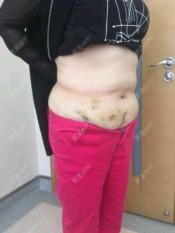 腰腹吸脂后1到7天恢復(fù)過(guò)程圖片展示，腰腹吸脂術(shù)后恢復(fù)過(guò)程圖片展示（1-7天）