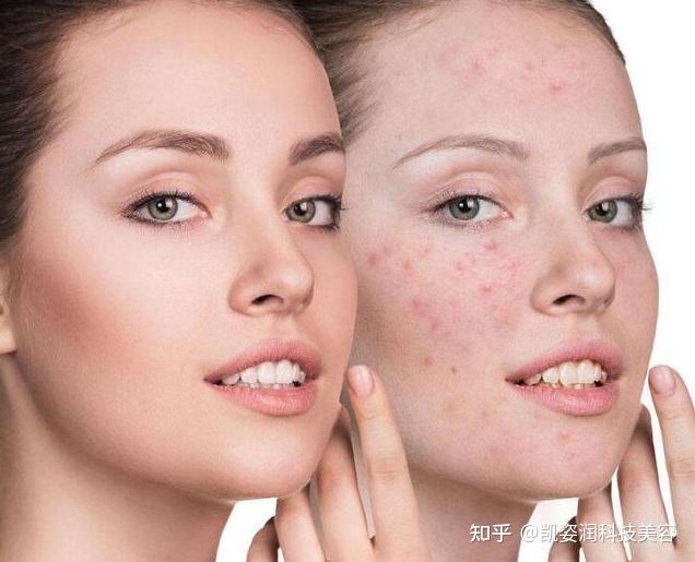 揭秘去痘痘最有效的方法，全方位攻略助你恢復無瑕肌膚，揭秘全方位祛痘攻略，重塑無瑕肌膚的有效方法！