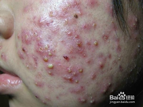 青春痘怎么解決，全方位預(yù)防與治療策略，全方位解決青春痘，預(yù)防與治療策略