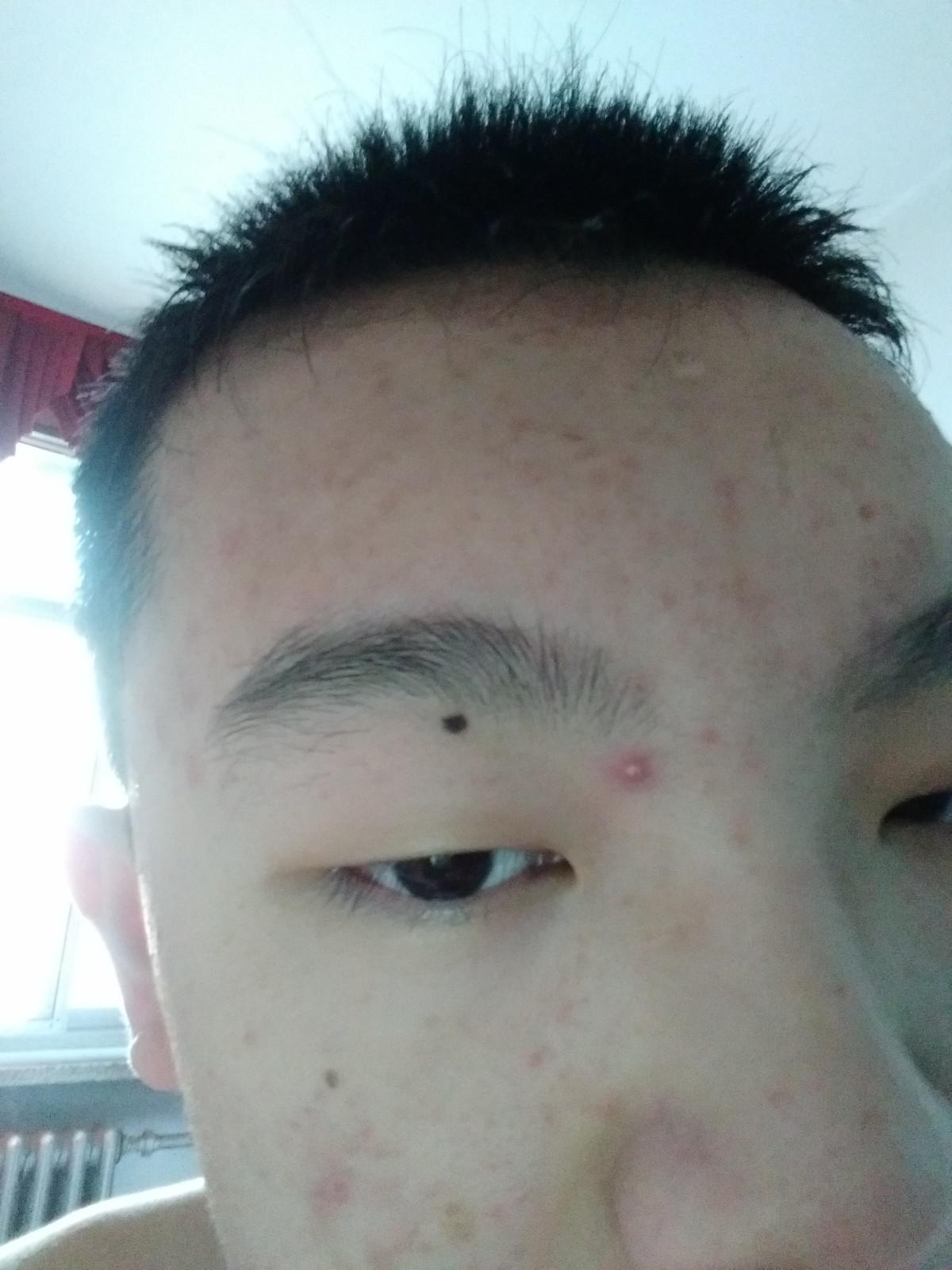 臉上痘痘太多了怎么辦？全方位護(hù)膚指南助你擺脫困擾，全方位護(hù)膚指南，解決臉部痘痘困擾，重拾肌膚光彩