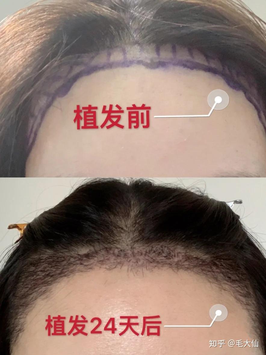 關(guān)于發(fā)際線植發(fā)的費用，你需要知道的一切，發(fā)際線植發(fā)費用全解析