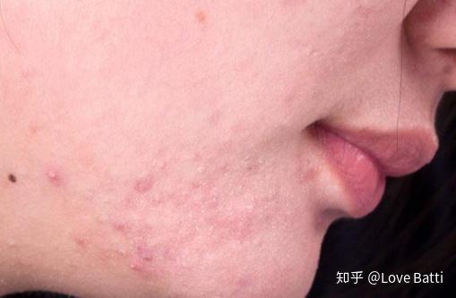 如何判斷臉上是否有螨蟲，全面解析與應(yīng)對建議，全面解析，如何判斷臉上是否有螨蟲及應(yīng)對建議