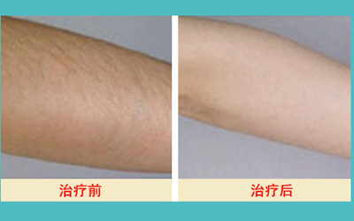 激光脫毛的價(jià)格解析，多少錢才能擁有絲滑肌膚？，激光脫毛價(jià)格詳解，多少錢能擁有絲滑肌膚？