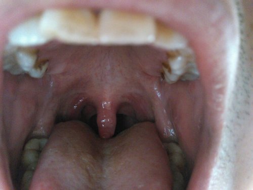 嗓子感覺糊了一層粘液，原因、緩解與預(yù)防策略，嗓子糊粘液，成因、緩解及預(yù)防策略