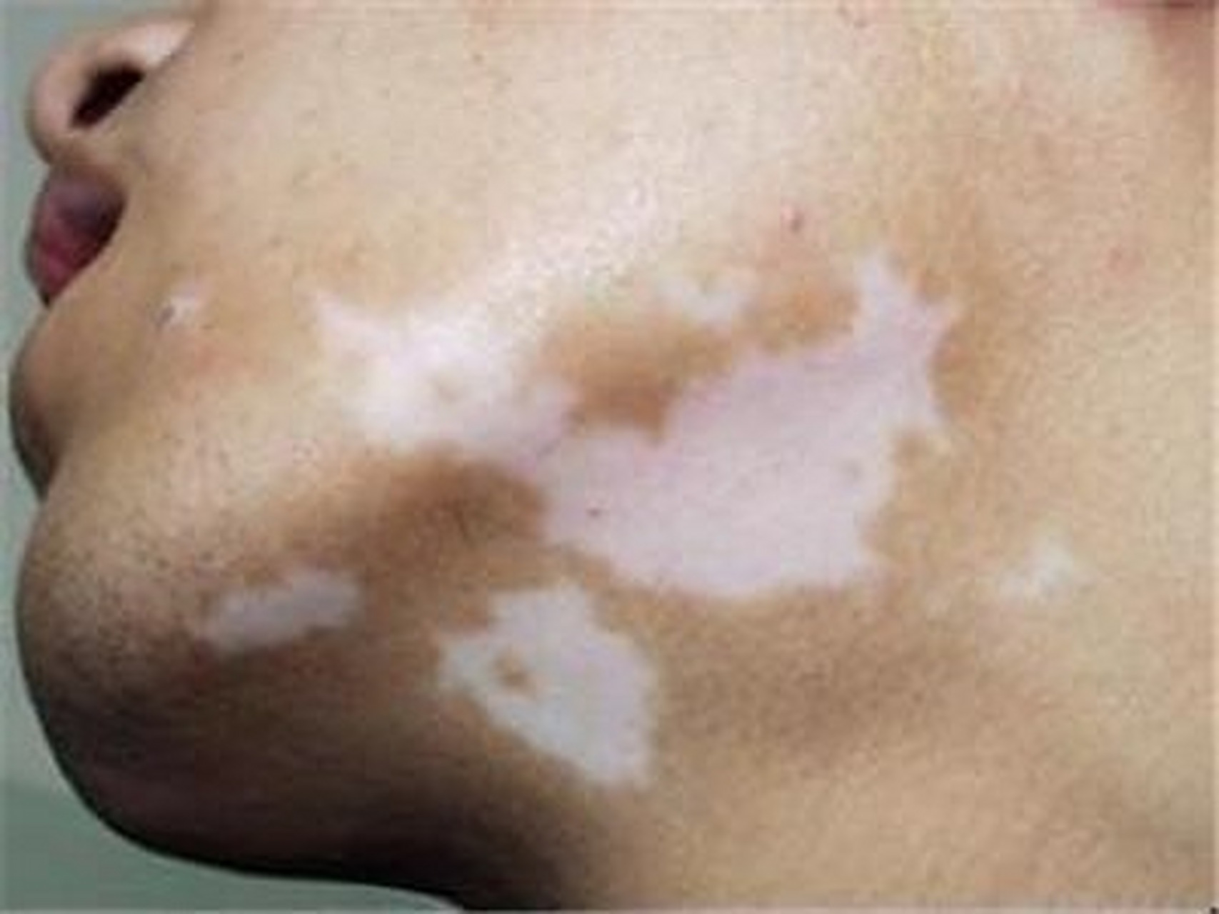 白點癲風(fēng)怎么治療效果最好，全面解析最佳治療方案，全面解析白點癲風(fēng)最佳治療方案，治療效果最大化