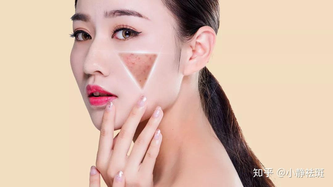 如何有效去除臉上的雀斑，最佳方法全解析，全面解析，如何有效去除臉上雀斑的方法