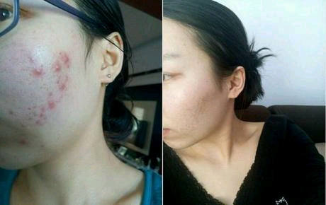 長青春痘怎么處理最好？全面解析最佳應(yīng)對策略，全面解析青春痘最佳應(yīng)對策略，最佳處理方法與建議