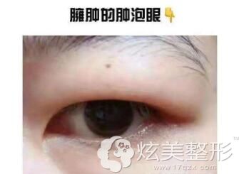 腫眼泡抽脂手術(shù)費(fèi)用詳解，多少錢？，腫眼泡抽脂手術(shù)費(fèi)用解析，手術(shù)費(fèi)用究竟是多少？