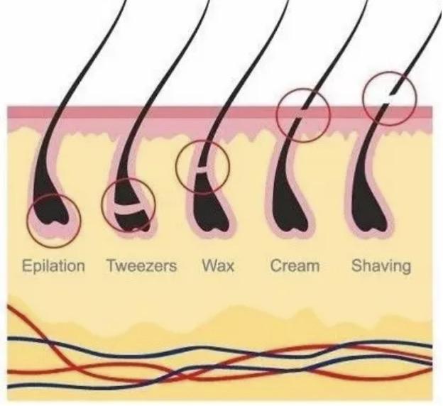 關(guān)于去醫(yī)院脫毛的價格解析，費用因素與大致預(yù)算，醫(yī)院脫毛價格詳解，費用因素與預(yù)算指南