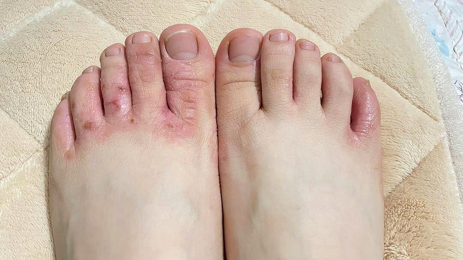 腳氣爛腳趾縫癢潰爛的治療方法，全面解析與應(yīng)對策略，腳氣爛腳趾縫癢潰爛全面解析與治療策略
